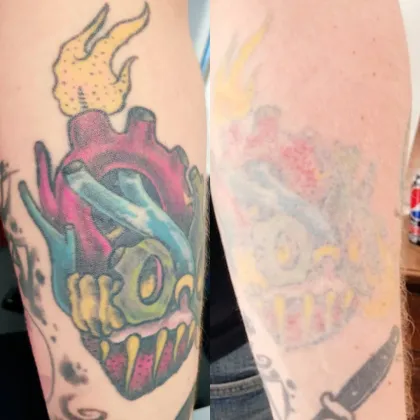 A bright colour heart tattoo before laser, then heavily faded after sessions
