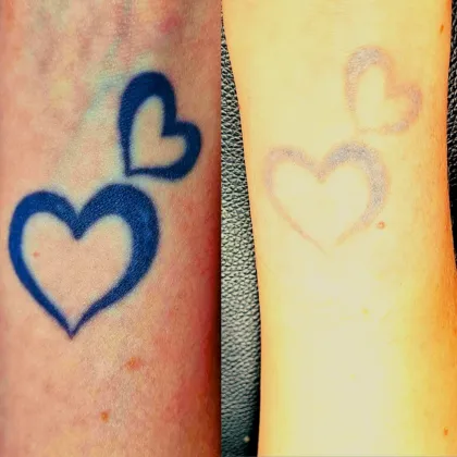 Blue outline hearts before laser, then almost gone after sessions