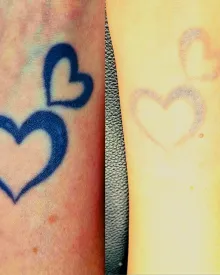 Blue outline hearts before laser, then almost gone after sessions with RazaLight