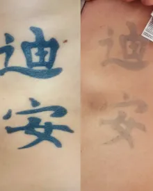 Blue kanji characters before laser, then much lighter after sessions with RazaLight