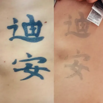 Two blue kanji characters before laser, then much lighter after sessions