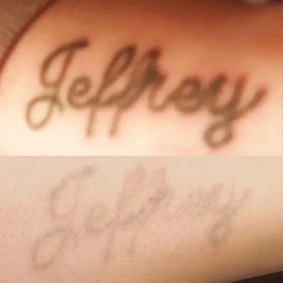 Laser removal progress: a name tattoo before treatment and faded right back after laser sessions with RazaLight