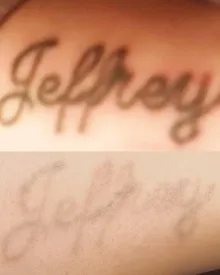 A script name tattoo before laser, then faded right back after sessions with RazaLight