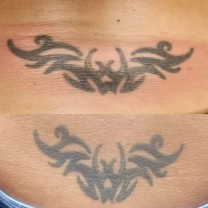 A dark tribal lower-back tattoo before laser, then fading after sessions